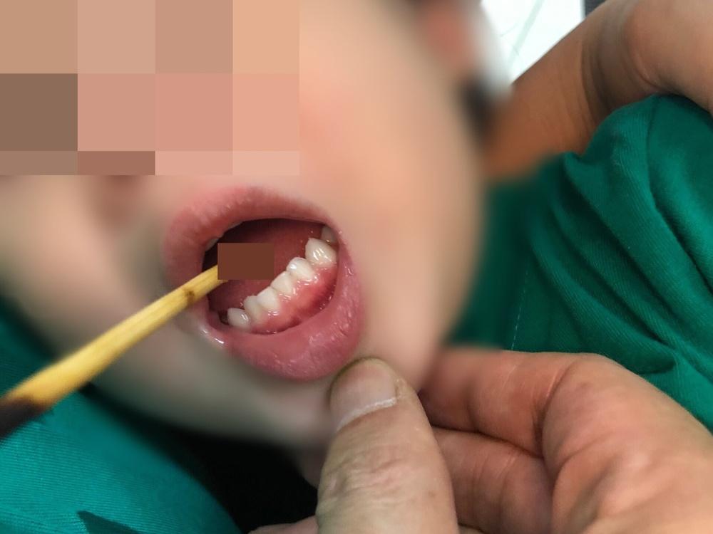 Tai nạn khiến bé 3 tuổi thủng lưỡi